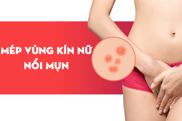 Mép vùng kín nữ nổi mụn là bị bệnh gì? Có sao không?