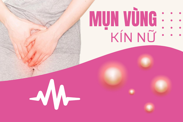Nổi mụn vùng kín nữ – Nguyên nhân và cách xử lý hiệu quả