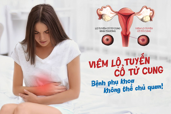 Viêm lộ tuyến cổ tử cung – Nguyên nhân, dấu hiệu và cách chữa trị