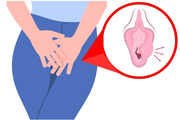 Dấu hiệu viêm tuyến Bartholin là gì? Bệnh có tự khỏi không?