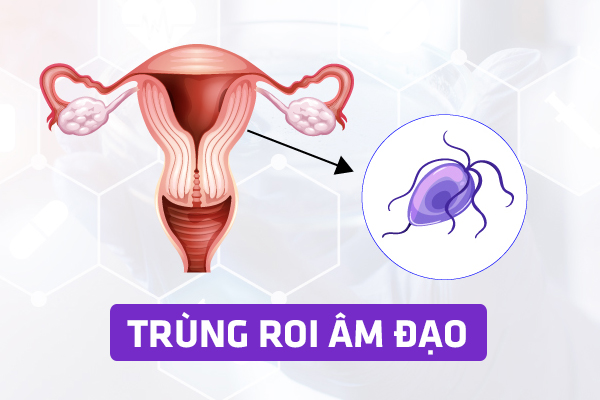 Bệnh trùng roi âm đạo – Dấu hiệu và cách chữa trị hiệu quả