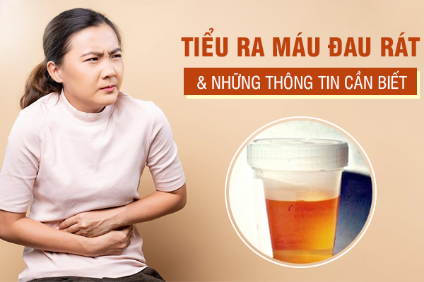 Đi tiểu ra máu đau rát ở nữ cảnh báo bệnh gì?