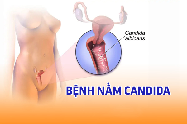 Nấm Candida – Nguyên nhân, dấu hiệu và cách chữa trị hiệu quả