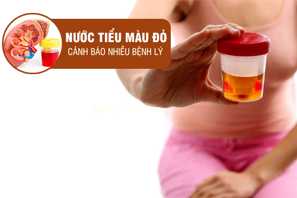 Nước tiểu màu đỏ cảnh báo bệnh gì? Có sao không?